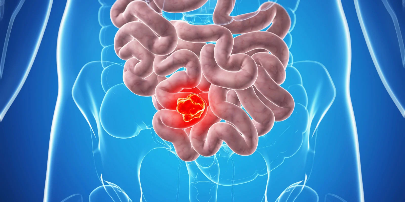 colonoscopie endoscopie